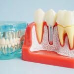 Proteză dentară vs. implant dentar: care este mai bun pentru tine?