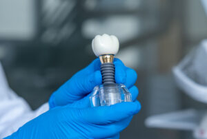 Unrecognizable doctor holding dental layout of upper veneers of teeth prothesis